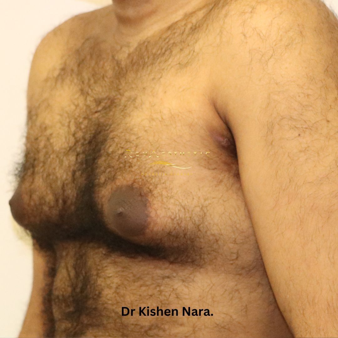 Chest liposuction + periareolar mastopexy + subcutaneous mastectomy — Anterior view — before